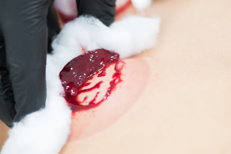Blood is the basis of health and disease.. The magical role of cupping to revive the body physically and psychologically