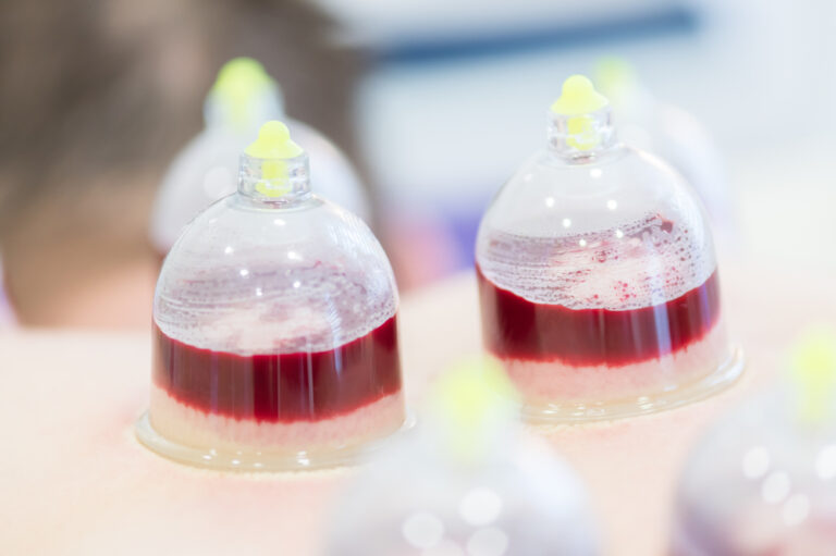 Treatment of “varicocele” by cupping… A model of practical experience