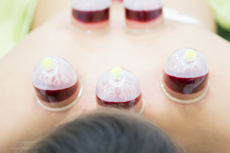Cupping is the secret of winning the medals of the 2016 Rio Olympics